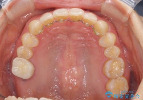 隙間だらけの歯列をきれいに インビザライン矯正とセラミック補綴治療の治療後
