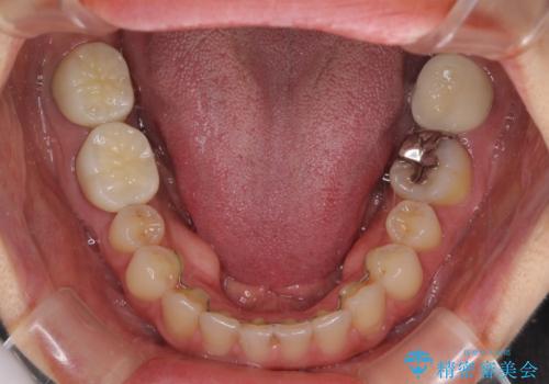 隙間だらけの歯列をきれいに インビザライン矯正とセラミック補綴治療の治療後