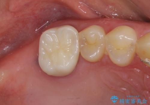 隙間だらけの歯列をきれいに インビザライン矯正とセラミック補綴治療の治療後