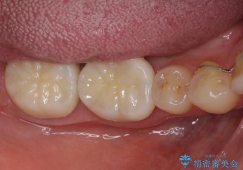 隙間だらけの歯列をきれいに インビザライン矯正とセラミック補綴治療の治療後