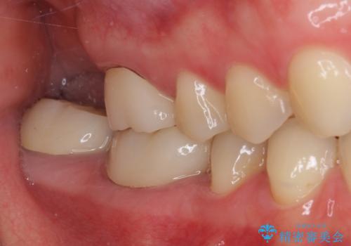 隙間だらけの歯列をきれいに インビザライン矯正とセラミック補綴治療の治療後