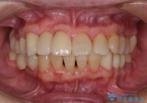 歯周病改善のための総合歯科治療の症例 治療後