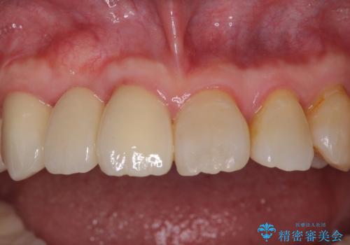 歯周病改善のための総合歯科治療の治療後