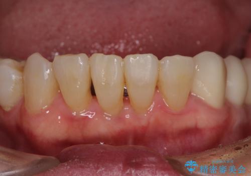 歯周病改善のための総合歯科治療の治療後