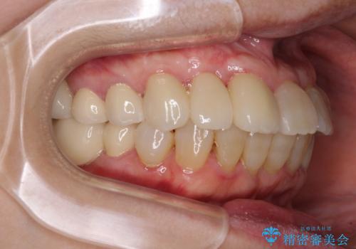 歯周病改善のための総合歯科治療の治療後