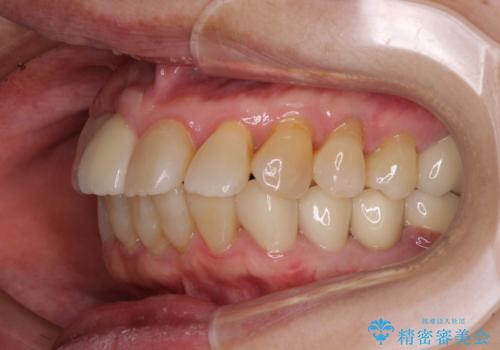 歯周病改善のための総合歯科治療の治療後