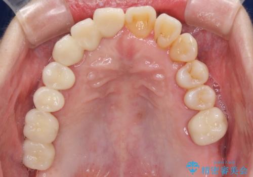 歯周病改善のための総合歯科治療の治療後