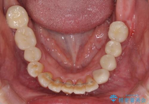 歯周病改善のための総合歯科治療の治療後