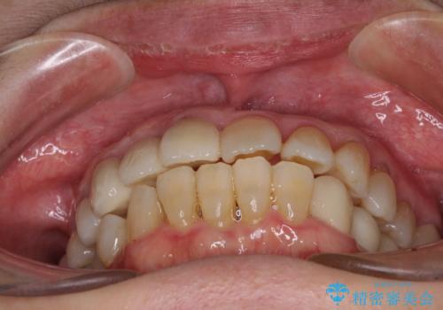 歯周病改善のための総合歯科治療の治療後