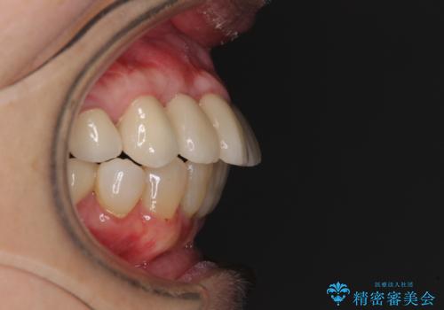 歯周病改善のための総合歯科治療の治療後