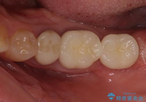 痛みを感じる奥歯 根管治療とインプラント治療の症例 治療後