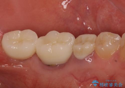 痛みを感じる奥歯 根管治療とインプラント治療の治療後