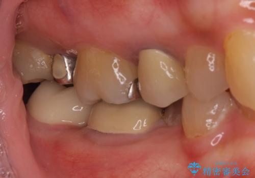 痛みを感じる奥歯 根管治療とインプラント治療の治療後