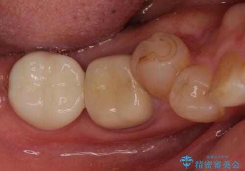 痛みを感じる奥歯 根管治療とインプラント治療の治療後