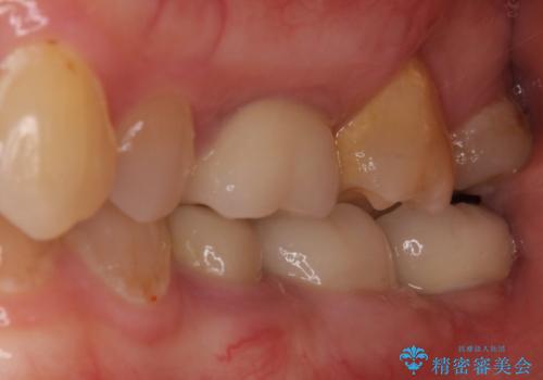 痛みを感じる奥歯 根管治療とインプラント治療の治療後