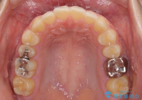 海外勤務中のインビザラインによる矯正治療の治療後
