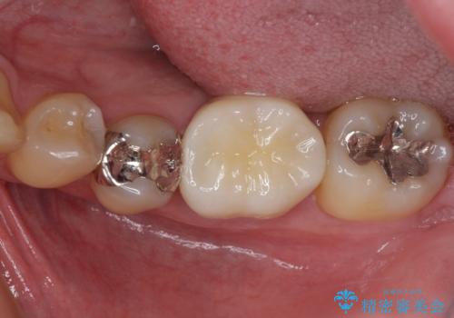 保険診療で装着した奥歯の白いクラウン　痛みが続くためセラミッククラウンへの症例 治療後