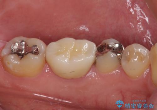 保険診療で装着した奥歯の白いクラウン 痛みが続くためセラミッククラウンへの治療後