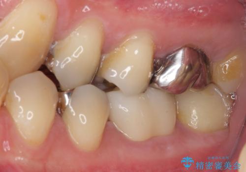 保険診療で装着した奥歯の白いクラウン 痛みが続くためセラミッククラウンへの治療後