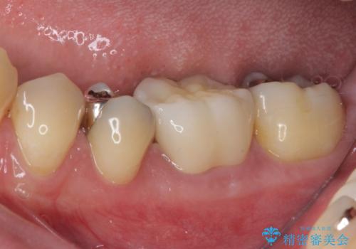 保険診療で装着した奥歯の白いクラウン 痛みが続くためセラミッククラウンへの治療後