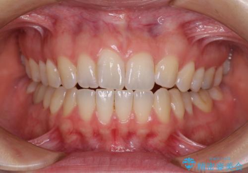 気になる上の歯を改善　インビザライン矯正の症例 治療前