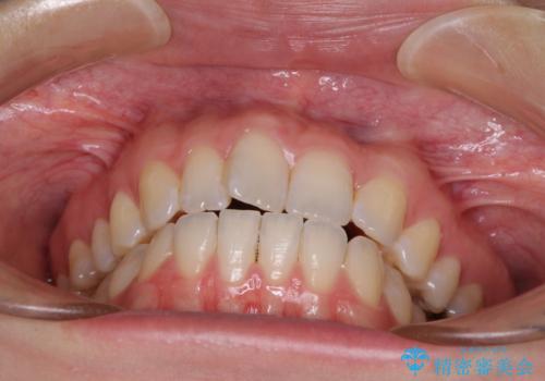 気になる上の歯を改善 インビザライン矯正の治療前