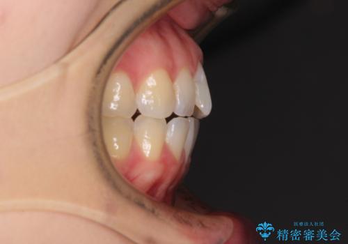気になる上の歯を改善　インビザライン矯正の治療前