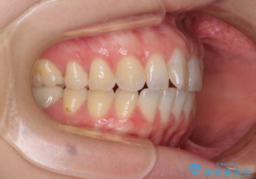 気になる上の歯を改善 インビザライン矯正の治療前
