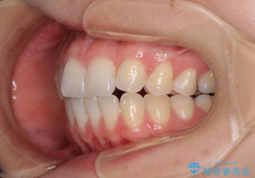 気になる上の歯を改善 インビザライン矯正の治療前