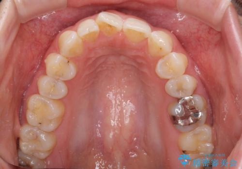 気になる上の歯を改善　インビザライン矯正の治療前