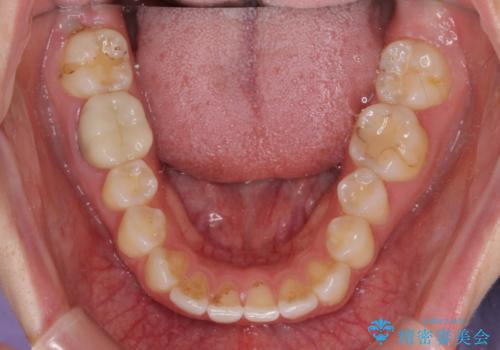 気になる上の歯を改善 インビザライン矯正の治療前
