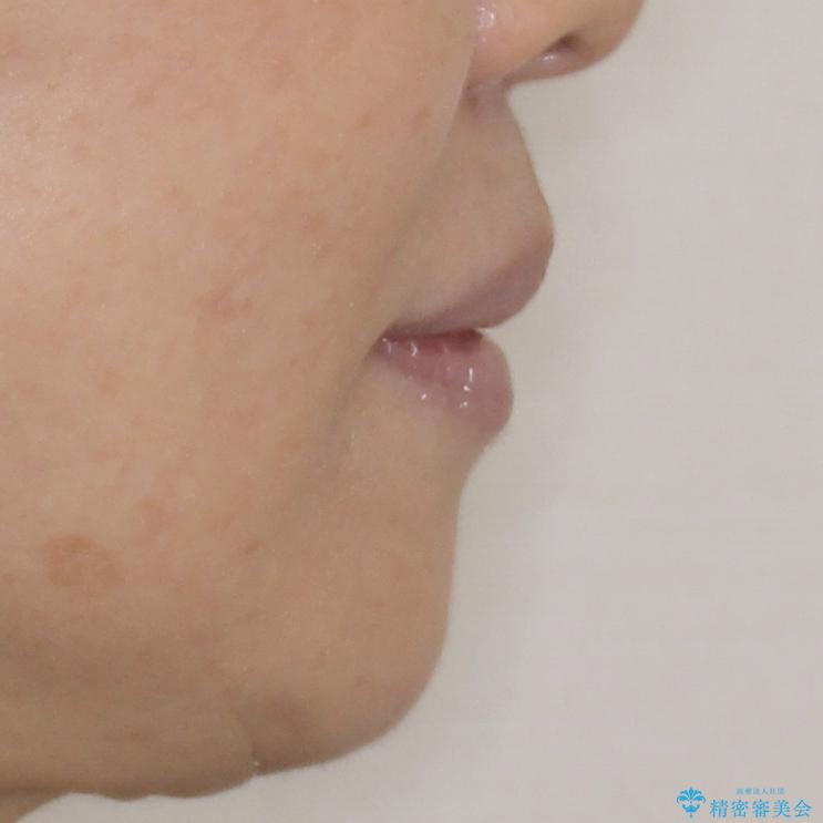 閉じにくい口元を改善したい ワイヤー装置での抜歯矯正の治療後(顔貌)