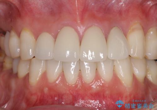 矯正しても虫歯が気になる 前歯のオールセラミッククラウンの治療後