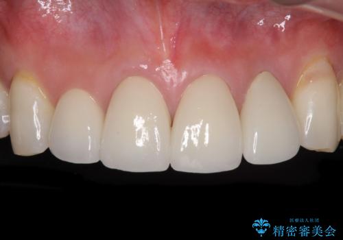 矯正しても虫歯が気になる 前歯のオールセラミッククラウンの治療後
