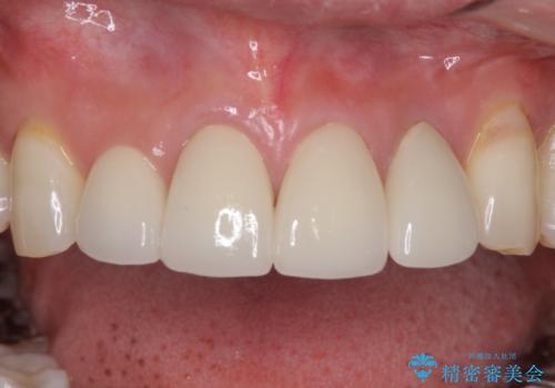 矯正しても虫歯が気になる 前歯のオールセラミッククラウンの治療後
