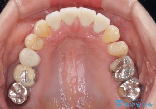 矯正しても虫歯が気になる 前歯のオールセラミッククラウンの治療後