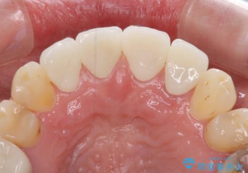 矯正しても虫歯が気になる 前歯のオールセラミッククラウンの治療後