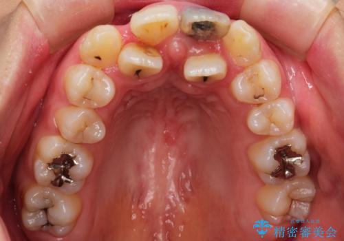 前歯が黒い セラミックで綺麗に 20代女性の治療前