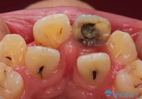 前歯が黒い セラミックで綺麗に 20代女性の治療前