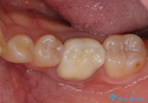 形が気に入らない 奥歯のオールセラミッククラウンの症例 治療後
