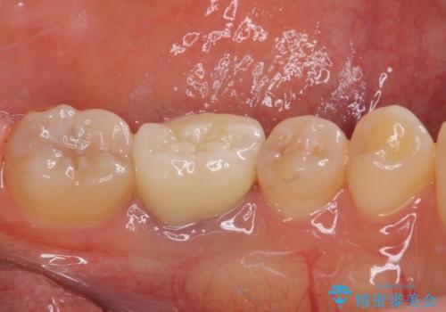 形が気に入らない 奥歯のオールセラミッククラウンの治療後