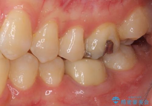形が気に入らない 奥歯のオールセラミッククラウンの治療後