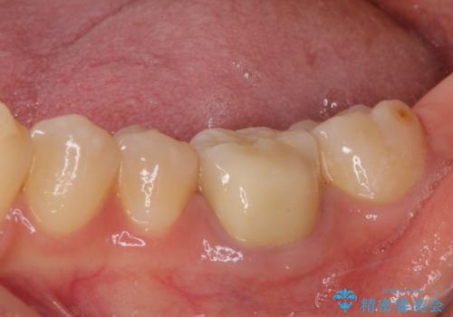 形が気に入らない 奥歯のオールセラミッククラウンの治療後
