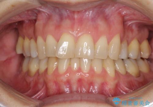 矯正の後戻りの改善と銀歯をセラミックにの症例 治療前