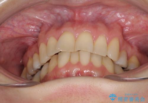 矯正の後戻りの改善と銀歯をセラミックにの治療前