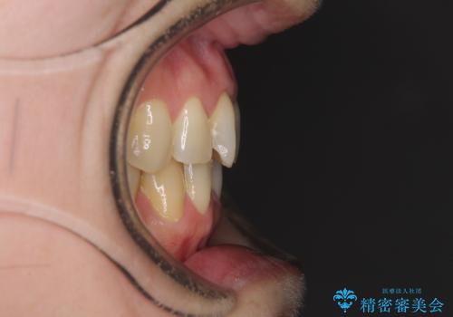 矯正の後戻りの改善と銀歯をセラミックにの治療前