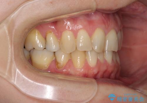 矯正の後戻りの改善と銀歯をセラミックにの治療前