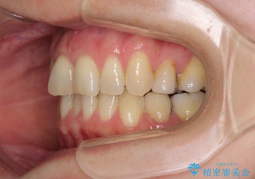 矯正の後戻りの改善と銀歯をセラミックにの治療前