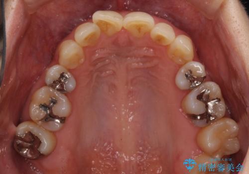 矯正の後戻りの改善と銀歯をセラミックにの治療前