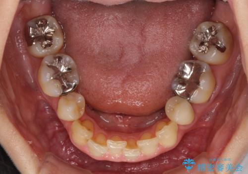矯正の後戻りの改善と銀歯をセラミックにの治療前